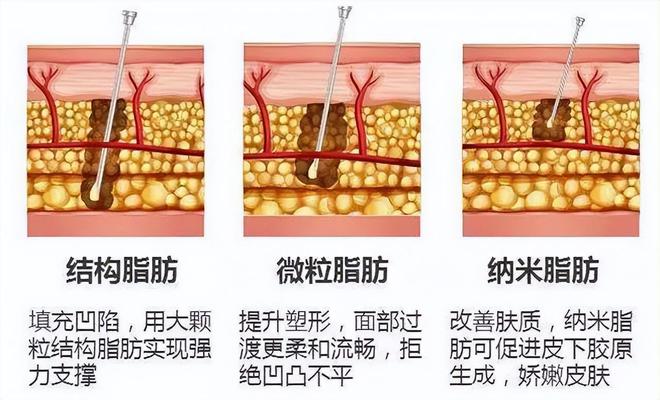 纳米脂肪的神奇用途你知道吗?(图1) 纳米脂肪的神奇用途你知道吗?(图1)